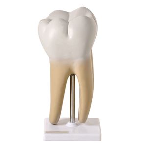 Dente Molar Ampliado - Saudável e com Cáries
