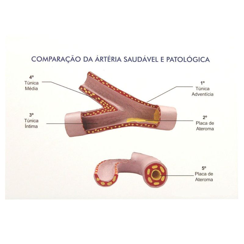 comparacao-da-arteria-saudavel-e-patologica....centermedical.com.br