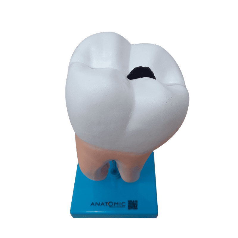 dente-molar-ampliado-anatomic-saudavel-e-com-caries.centermedical.com.br2
