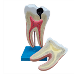dente-molar-ampliado-anatomic-saudavel-e-com-caries.centermedical.com.br3