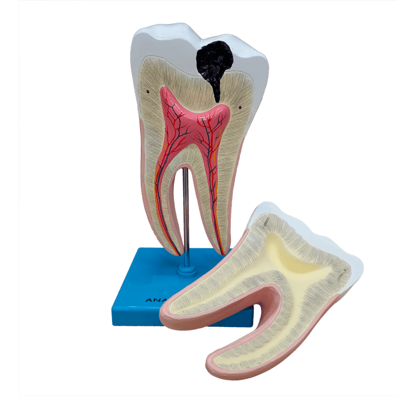 dente-molar-ampliado-anatomic-saudavel-e-com-caries.centermedical.com.br3