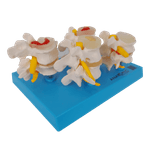 Demonstracao-de-Degeneracao-das-Vertebras-em-4-Fases-Center-Medical1