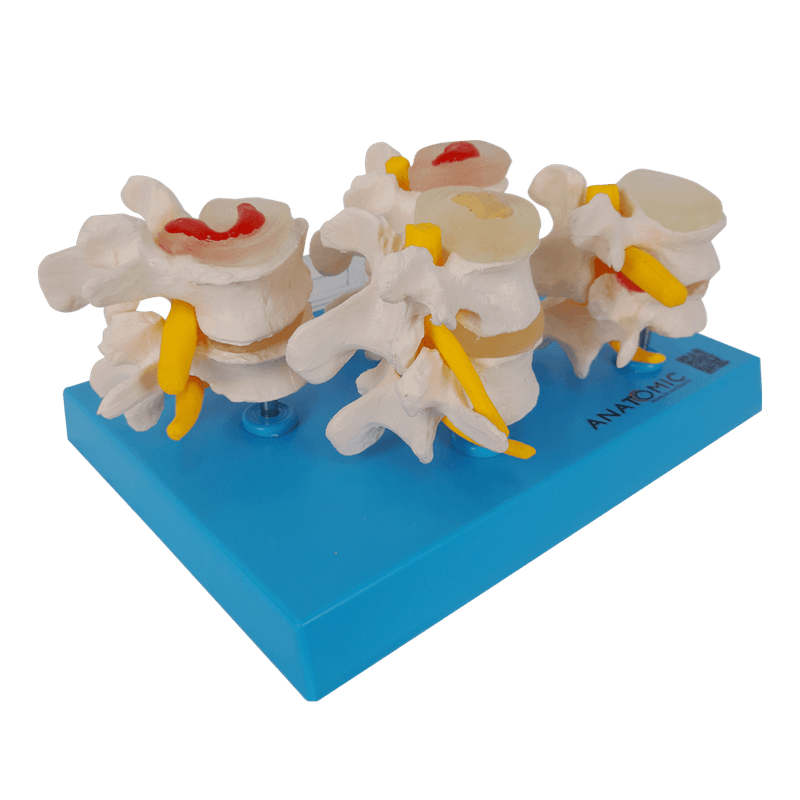 Demonstracao-de-Degeneracao-das-Vertebras-em-4-Fases-Center-Medical1