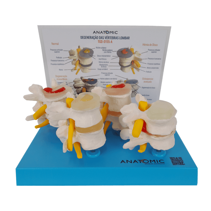 Demonstracao-de-Degeneracao-das-Vertebras-em-4-Fases-Center-Medical5