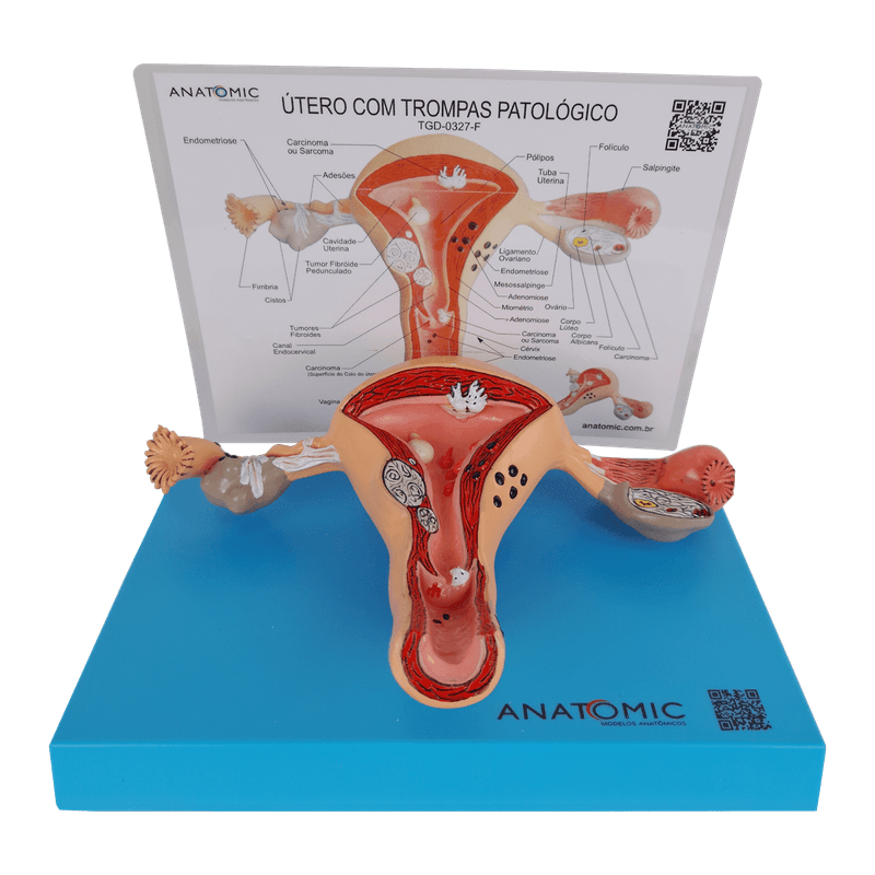 Utero-com-Trompas-Patologico-Center-Medical