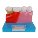 Patologia-dos-Dentes-com-Placa-Explicativa-Center-Medical