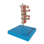 Osteoporose-4-Vertebras-Center-Medical