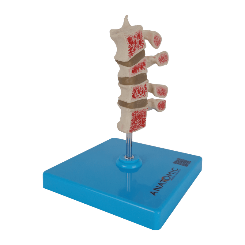 Osteoporose-4-Vertebras-Center-Medical