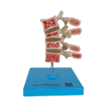 Osteoporose-4-Vertebras-Center-Medical